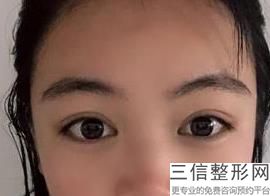 年南京比较好的双眼皮整形机构排名大公开,南京三甲医院整形双眼皮排行