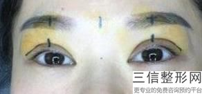 年青岛眼部手术排名前三整形医院,青岛眼科医院双眼皮手术