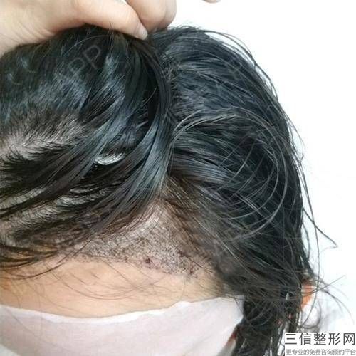 年武汉青山区良好的植发整形医院排名,武汉植发武汉新生植发医院好吗
