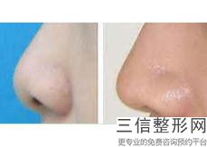 宁波隆鼻整形医院排名榜前五公布,宁波专业隆鼻整形手术