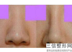 宁波隆鼻正规整形医院排名前四全新发布,宁波良好整形医院