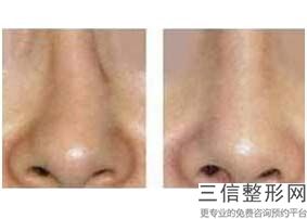宁波隆鼻正规整形医院排名前四全新发布,宁波良好整形医院