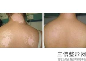 宁波热玛吉正规授权医院在线查询,热玛吉全国正规医院