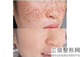 山东热玛吉官方授权医院认证排名榜出炉,五代热玛吉正规认证医院有哪些