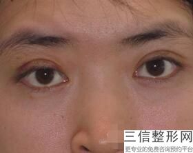 山东省割双眼皮医生排名榜前五推荐,山东省做双眼皮比较好的医院