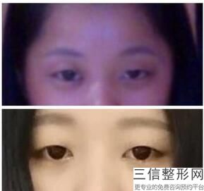 山东省割双眼皮医生排名榜前五推荐,山东省做双眼皮比较好的医院