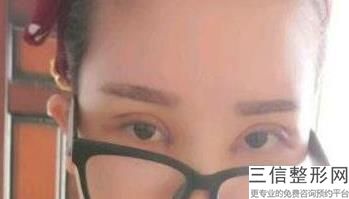 山西做双眼皮整形医院排行榜前十大同,山西省眼科医院谁做双眼皮好