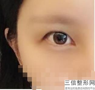 山西做双眼皮整形医院排行榜前十大同,山西省眼科医院谁做双眼皮好