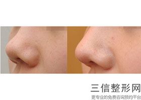 陕西省隆鼻医院排名前五发布,西安良好的隆鼻医院叫什么
