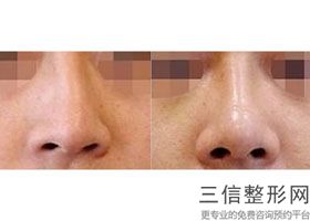 陕西省西安鼻整形医院排名榜前五汇聚,西安鼻部整形效果