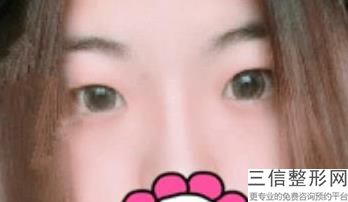 陕西西安眼科整形医院排名榜前五口碑推荐,西安眼部整形医生排名
