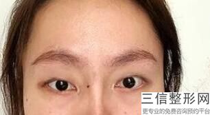 陕西西安眼科整形医院排名榜前五口碑推荐,西安眼部整形医生排名