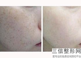 汕头热玛吉官方授权医院排名表,海南热玛吉认证医院