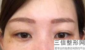 汕头双眼皮整形医院排名榜来啦,汕头市中心医院割双眼皮