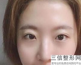 汕头双眼皮整形医院排名榜来啦,汕头市中心医院割双眼皮