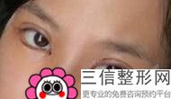 汕头双眼皮整形医院排名榜来啦,汕头市中心医院割双眼皮