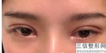 汕头双眼皮整形医院排名榜来啦,汕头市中心医院割双眼皮