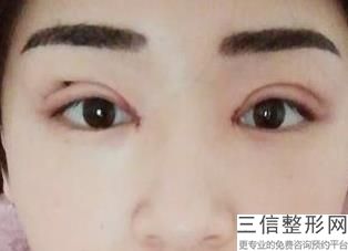 汕头双眼皮整形医院排名前三口碑盘点,汕头割双眼皮
