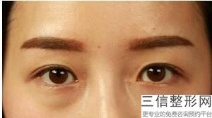汕头双眼皮整形医院排名前三口碑盘点,汕头割双眼皮