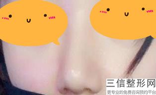 上海鼻头肥大整形医院排名榜六强点评,上海鼻部整形良好医院