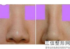 上海鼻整形医生排名四大权威专家盘点,上海有名的鼻整形医生