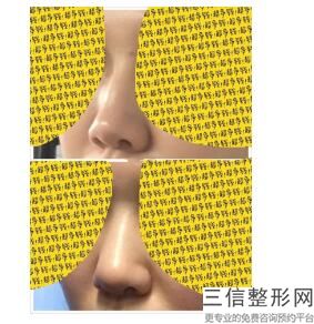 上海鼻整形医生排名四大权威专家盘点,上海有名的鼻整形医生
