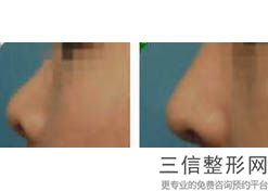 上海鼻子整形好的医院排名表在此,上海整形鼻子选什么医院好