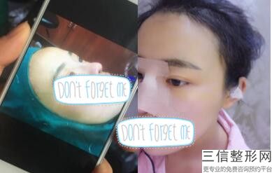 上海鼻子整形好的医院排名表在此,上海整形鼻子选什么医院好