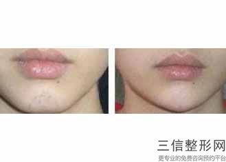 上海唇部整形三甲医院排名前十尽显,中国良好的唇部整形医院