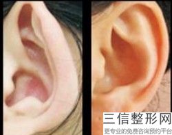 上海耳部整形医院排行榜前五权威盘点,上海耳整形哪里好