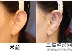 上海耳部整形医院排行榜前五权威盘点,上海耳整形哪里好