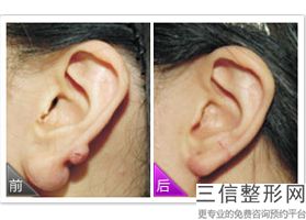 上海耳部整形医院排行榜四大知名机构揭晓,中国耳部整形良好的医院