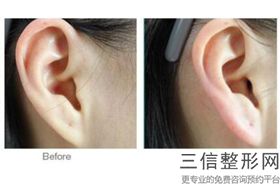 上海耳部整形医院排行榜四大知名机构揭晓,中国耳部整形良好的医院