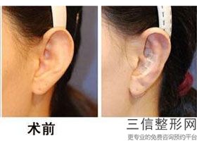 上海耳朵整形医院排行榜前十新版公布,耳朵整形上海哪家医院好