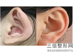 上海耳朵整形医院排行榜前十新版公布,耳朵整形上海哪家医院好