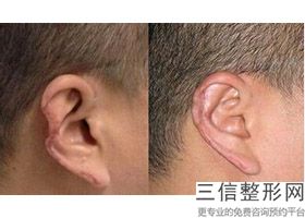 上海耳朵整形医院排名榜六强权威盘点,耳朵整形公立医院排名