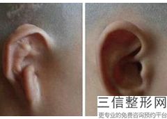 上海耳朵整形医院排名榜六强权威盘点,耳朵整形公立医院排名