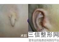 上海耳朵整形医院排名榜六强权威盘点,耳朵整形公立医院排名
