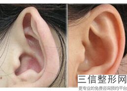 上海耳朵整形医院排名榜六强权威盘点,耳朵整形公立医院排名