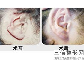 上海耳朵整形医院排名榜六强权威盘点,耳朵整形公立医院排名