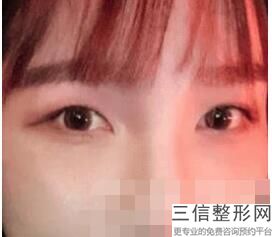 上海九医院双眼皮修复专家哪个好,上海第九人民医院修复双眼皮怎么样