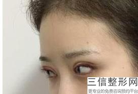上海九院双眼皮专家排名榜被苏薇洁,上海九院双眼皮医生
