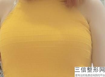 上海九院整形科隆胸专家介绍,上海九院隆胸医生