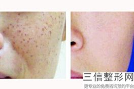 上海九院整形科热玛吉除皱好的医生有哪些,热玛吉除皱怎么样