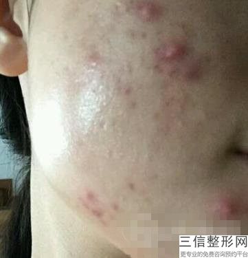 上海九院整形科热玛吉除皱好的医生有哪些,热玛吉除皱怎么样