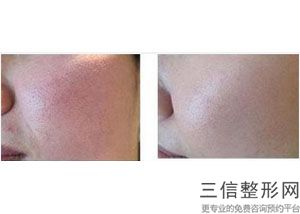 上海九院整形科热玛吉除皱好的医生有哪些,热玛吉除皱怎么样