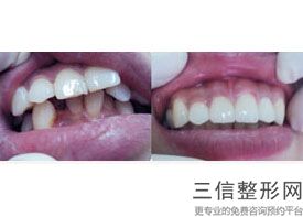 上海口腔医院牙齿矫正排名榜前六名单出炉,上海牙齿矫正正规医院排名
