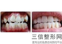 上海口腔医院牙齿矫正排名榜前六名单出炉,上海牙齿矫正正规医院排名