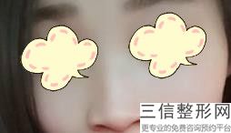 上海肋软骨隆鼻医院排名前八少有放送,软肋骨隆鼻手术
