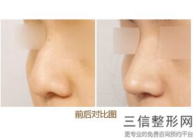 上海隆鼻好的整形医院排名榜前四强公布,上海鼻部整形医院排名前三的